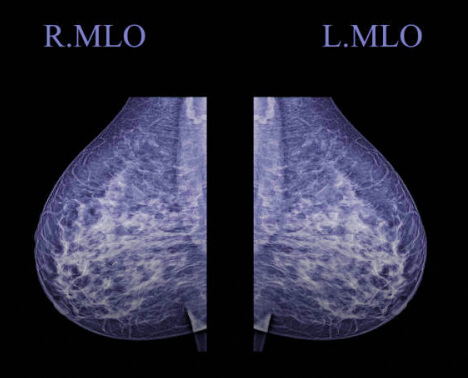 Image of a 3d digital mammograph