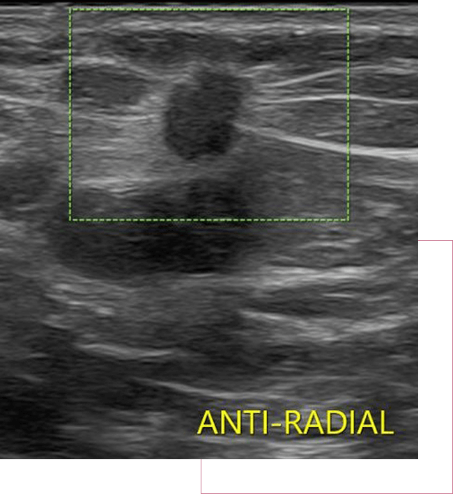 A 3d digital mammography