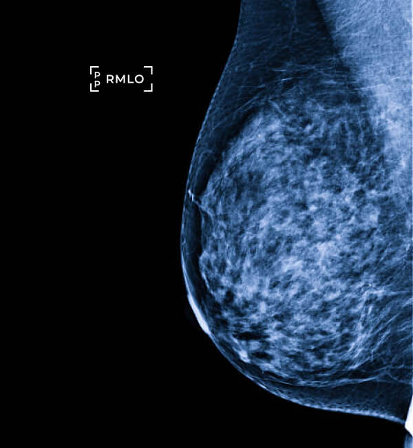 A 3d digital mammography