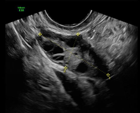 Image of pelvic ultra sound scan