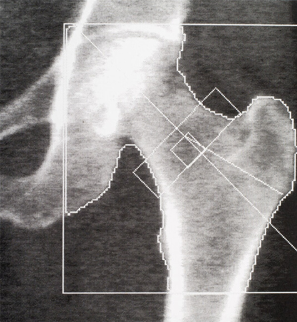 Image of a bone density scan