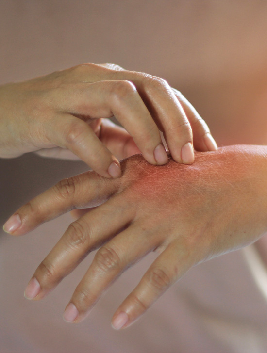 Image of one hand rubbing with another hand due to itching